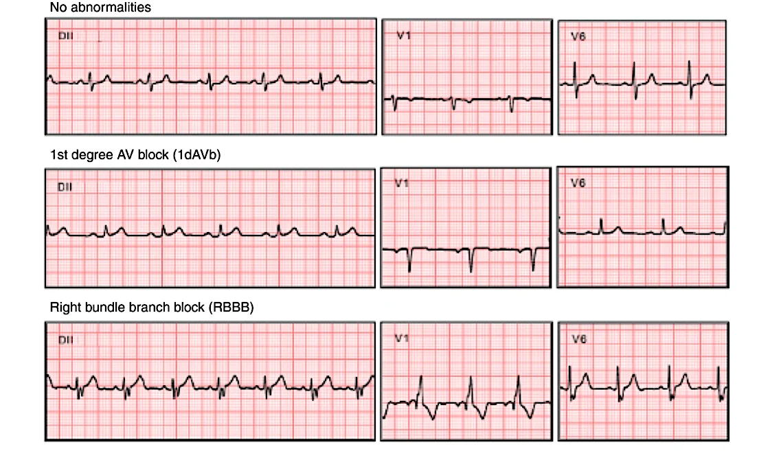 ECG/EKG